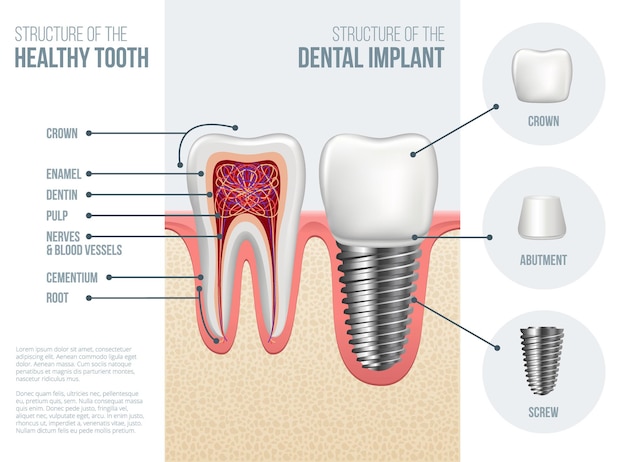 Vetor dente saudável realista com cárie e estrutura de implante dentário com parafuso de pilar de coroa