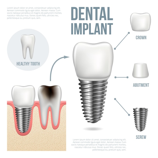 Dente saudável realista com cárie e estrutura de implante dentário com parafuso de pilar de coroa