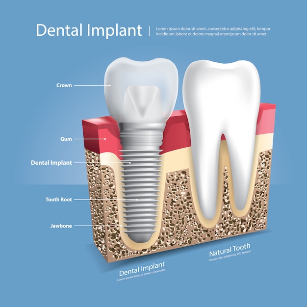 Dentes humanos e ilustração vetorial de implante dentário