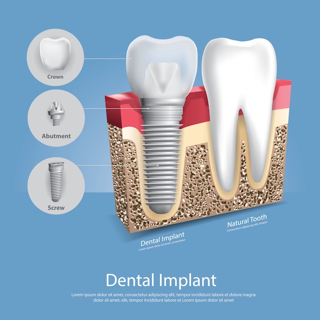 Vetor dentes humanos e ilustração vetorial de implante dentário