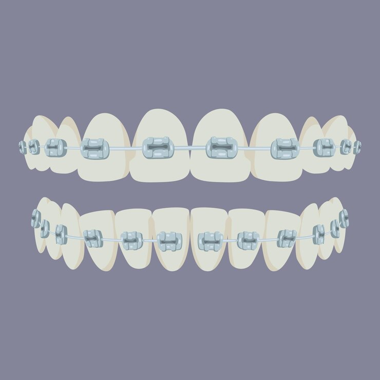 Vetor dentes limpos e lisos com aparelho dentes saudáveis