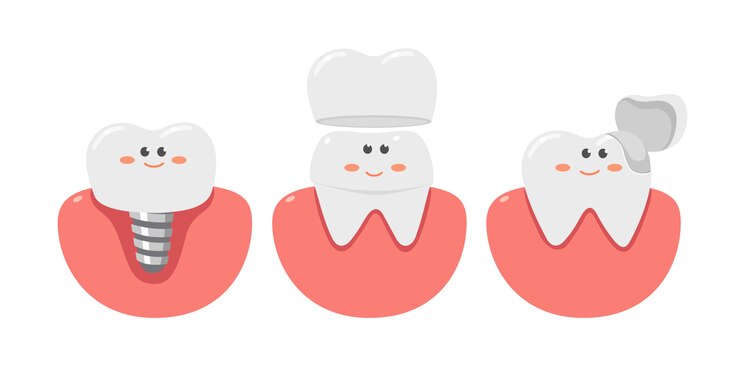 Dentes saudáveis com um implante dentário, cuidados de saúde.