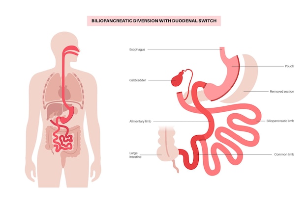 Derivação biliopancreática com interruptor duodenal bpd conceito de cirurgia estomacal perda de peso procedimento gástrico laparoscopia abdominal sobrepeso e obesidade na ilustração médica de vetor plano de corpo humano