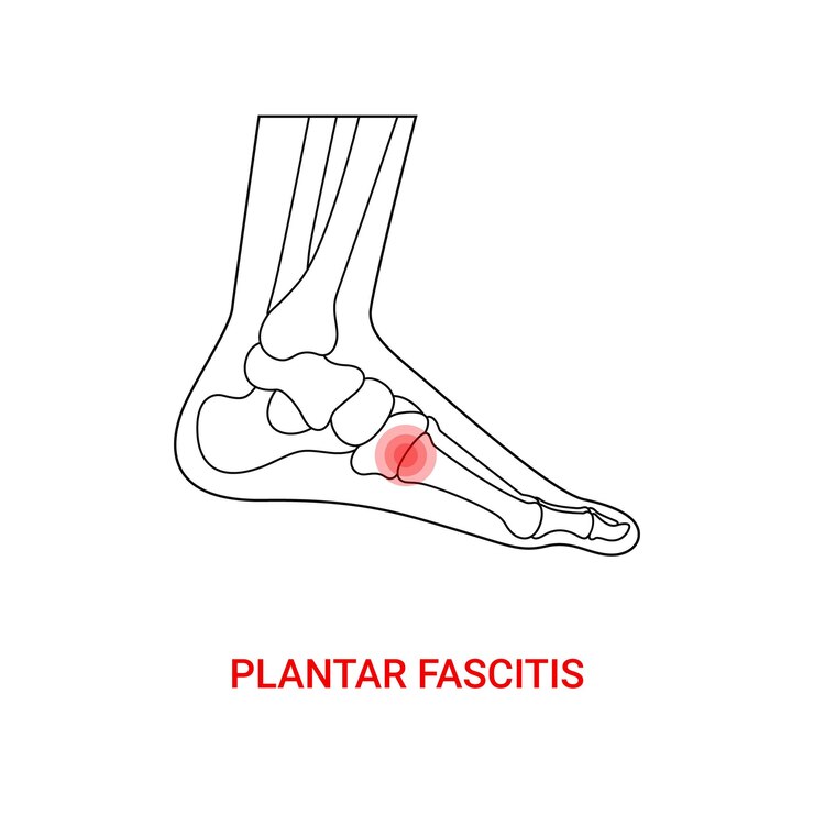 Vetor desenho médico de fascite plantar com estilo de linha