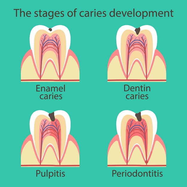 Vetor desenvolvimento de cárie dentária