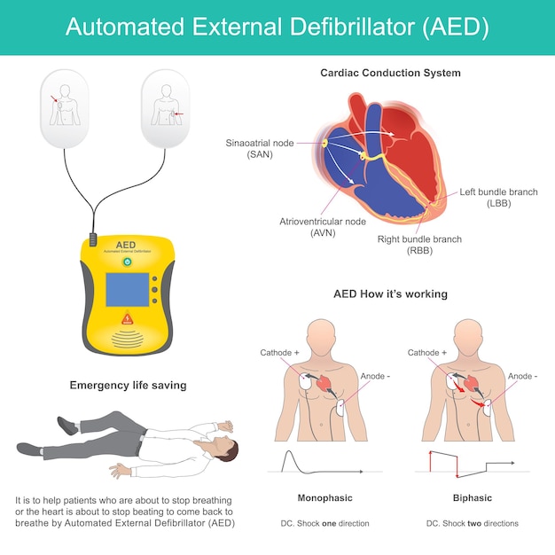 Vetor desfibrilador externo automático é um dispositivo eletrônico de suporte à vida que reconhece