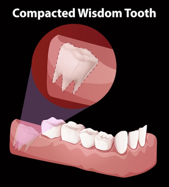 Vetor diagrama de dente de sabedoria compactado