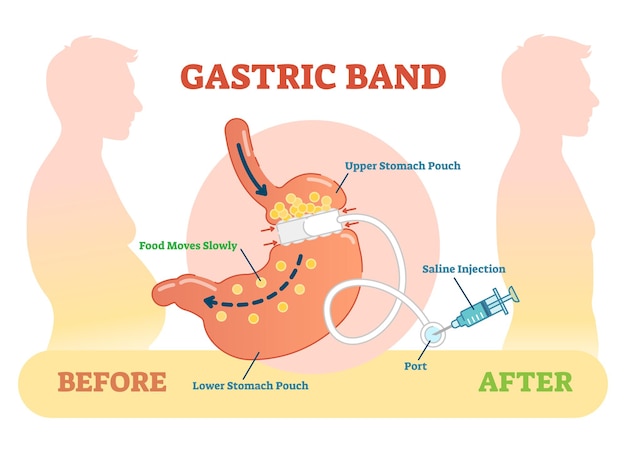 Diagrama de ilustração vetorial anatômica banda gástrica médica antes