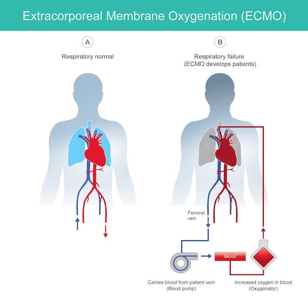 Diagrama de oxigenação por membrana extracorpórea para explicar a insuficiência respiratória de pacientes de resgate usando ecmo de oxigenação por membrana extracorpórea instrumental