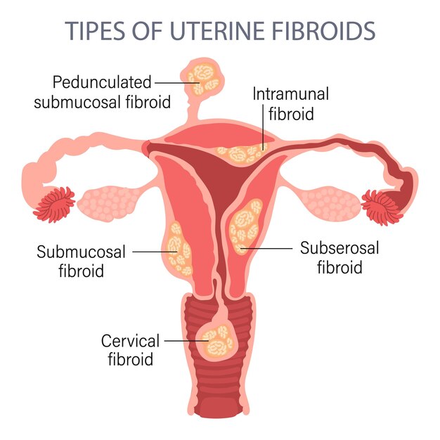 Diagrama de tipos de miomas uterinos em uma mulher em um fundo branco. Genicolgia. Conceito médico.