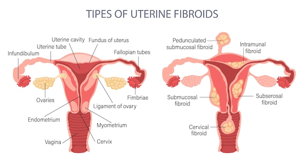 Diagrama dos tipos de miomas uterinos em uma mulher. Útero saudável e insalubre. Genicologia. Médico