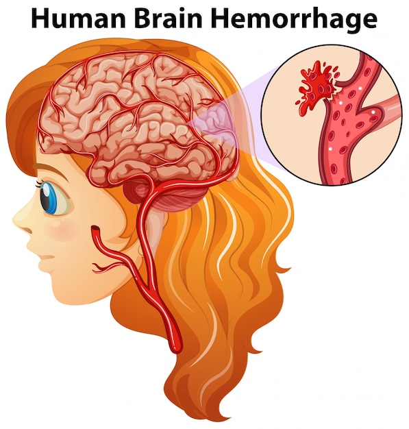 Diagrama mostrando a hemorragia cerebral humana