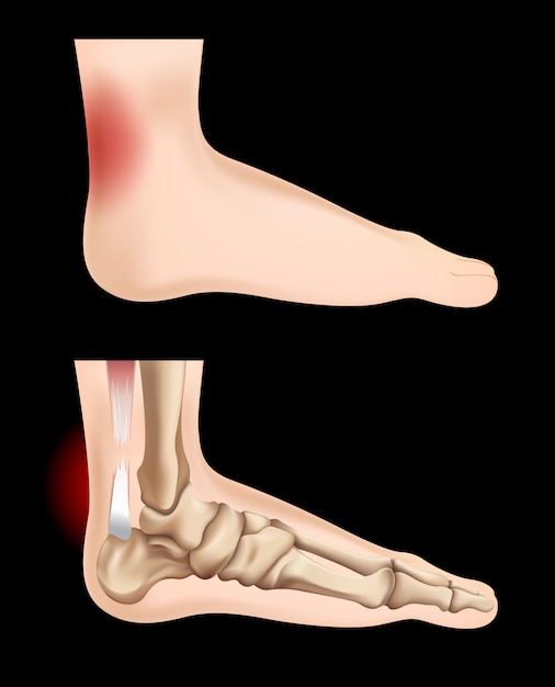 Diagrama mostrando lesão no tendão