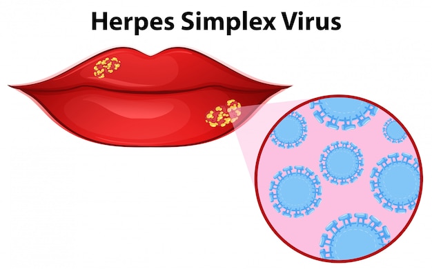 Diagrama mostrando o vírus herpes simplex