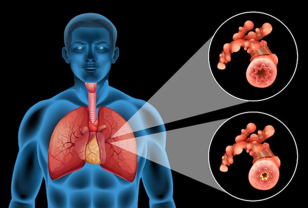 Diagrama mostrando pulmões e doenças humanas