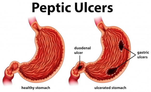 Diagrama mostrando úlceras pépticas