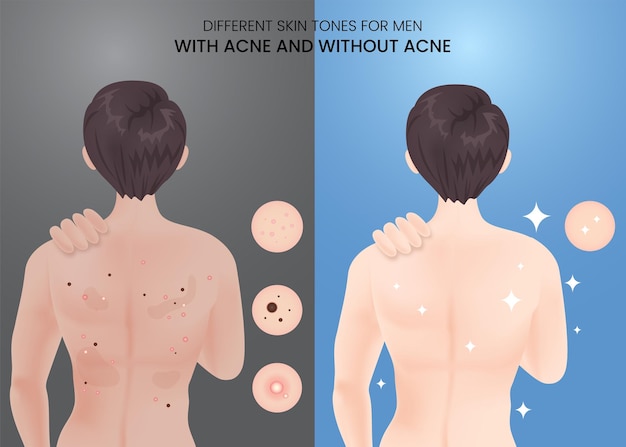 Diferentes tons de pele para homens com acne e sem acne