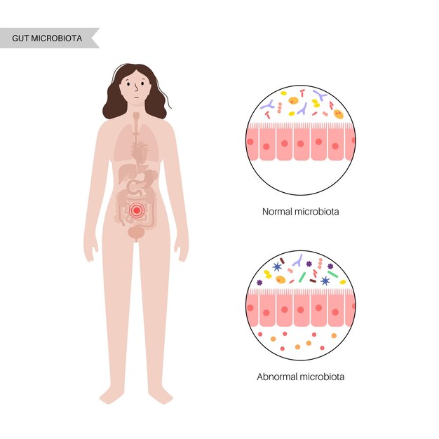 Vetor disbiose e microbiose da conexão do cérebro intestinal microbiota normal e anormal