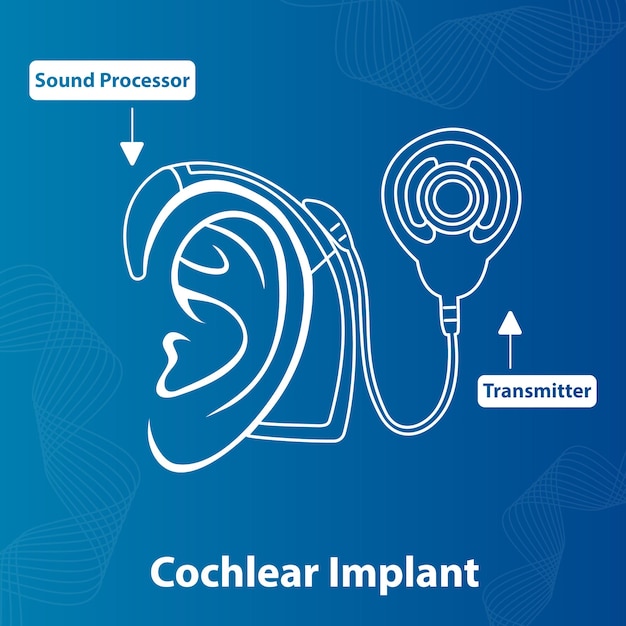 Dispositivo de implante coclear da orelha