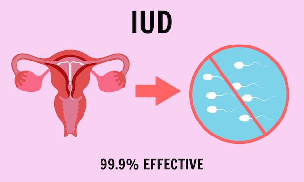 Vetor dispositivo intrauterino contracepção eficaz em vetor