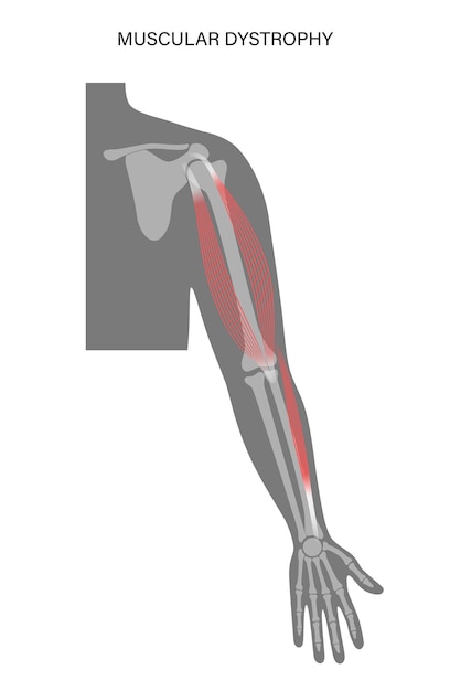 Vetor distrofia muscular do braço