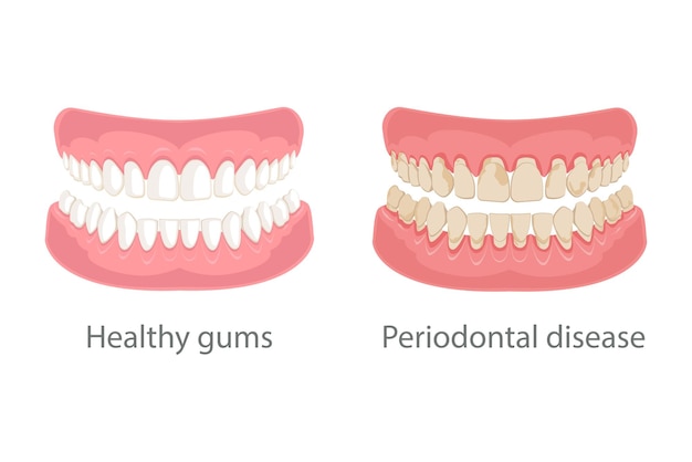 Vetor doença das gengivas e doença periodontal dos dentes