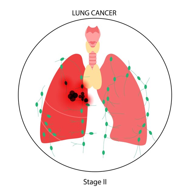 Vetor doença de câncer de pulmão