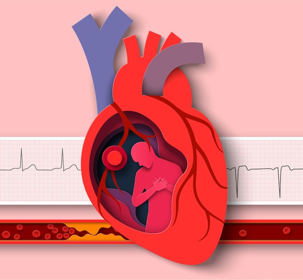 Doença de cardiologia vetorial de corte de papel de ataque cardíaco
