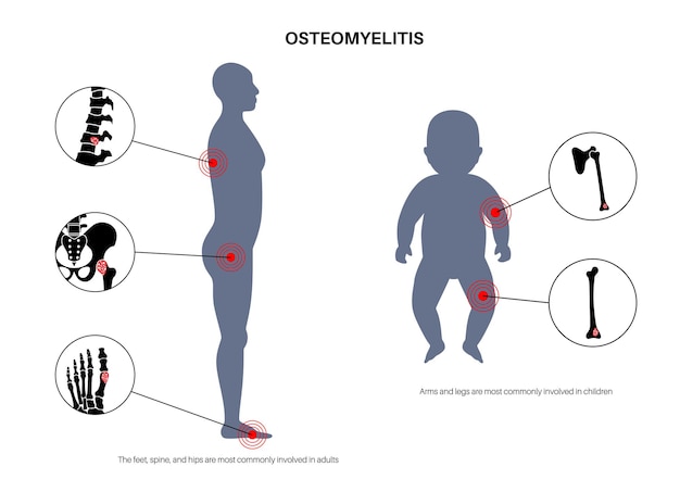 Vetor doença de osteomielite em adultos e crianças ossos infectados da coluna, pernas e braços a infecção se espalha pela corrente sanguínea até os ossos bactéria staphylococcus aureus no corpo humano vetor