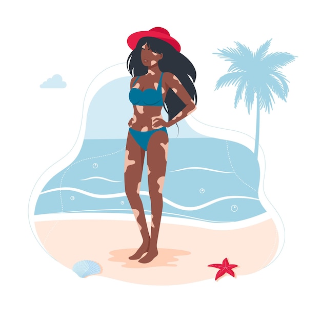 Doença de pele com vitiligo em uma garota afro-americana em um maiô. mulher com diagnóstico de vitiligo tomando banho de sol na praia não é tímida. o conceito de beleza diferente, auto-aceitação corporal positiva.