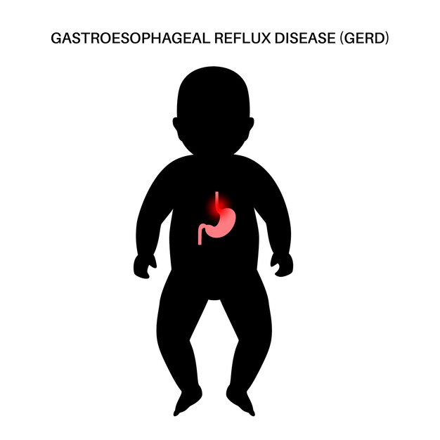 Doença do refluxo gastroesofágico na silhueta infantil. distúrbio digestivo e problema de drge no corpo do bebê humano. dor, azia no peito infantil, estômago e esôfago, ilustração vetorial de refluxo ácido