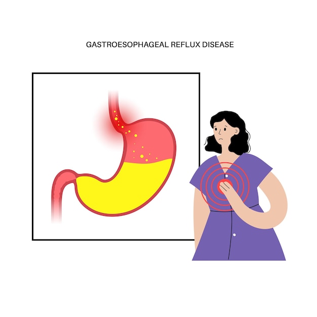 Vetor doença do refluxo gastroesofágico. paciente na clínica. distúrbio digestivo e drge no corpo humano. dor, azia no peito, estômago e esôfago. o esfíncter aberto permite a ilustração vetorial de refluxo ácido