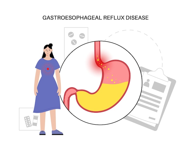 Doença do refluxo gastroesofágico. paciente na clínica. distúrbio digestivo e drge no corpo humano. dor, azia no peito, estômago e esôfago. o esfíncter aberto permite a ilustração vetorial de refluxo ácido