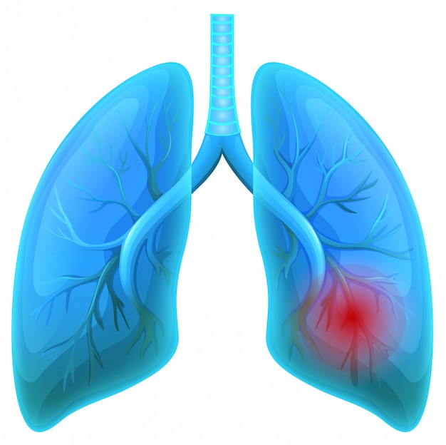 Doença pulmonar no fundo branco