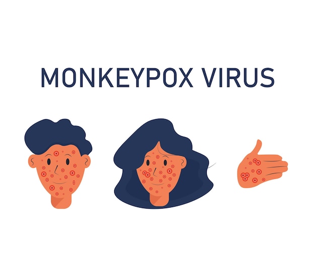 Doença viral zoonótica do vírus monkeypox que pode infectar primatas humanos não humanos monkey pox vector