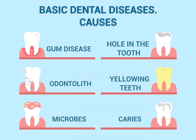 Vetor doenças dentárias, informação da doença da cavidade poster