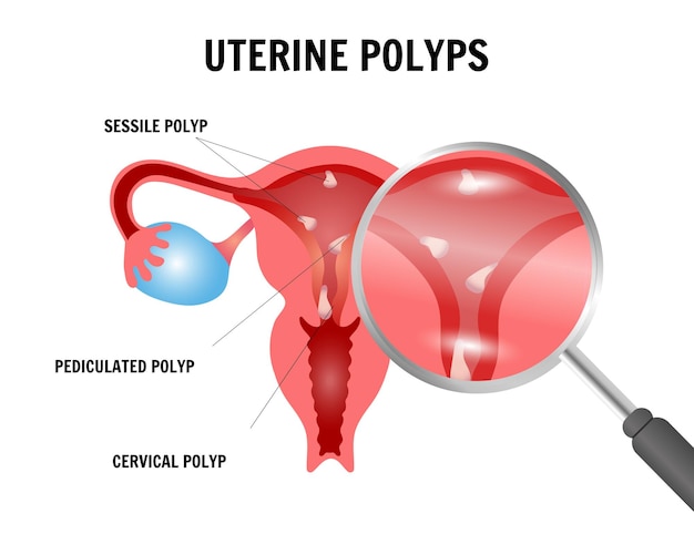 Vetor doenças médicas ginecológicas pólipos uterinos em ilustração vetorial