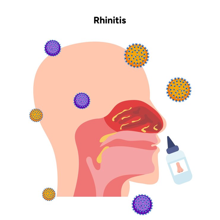 Vetor doenças nasais sintomas da rinite alergia da rinite vírus do resfriado e spray nasal