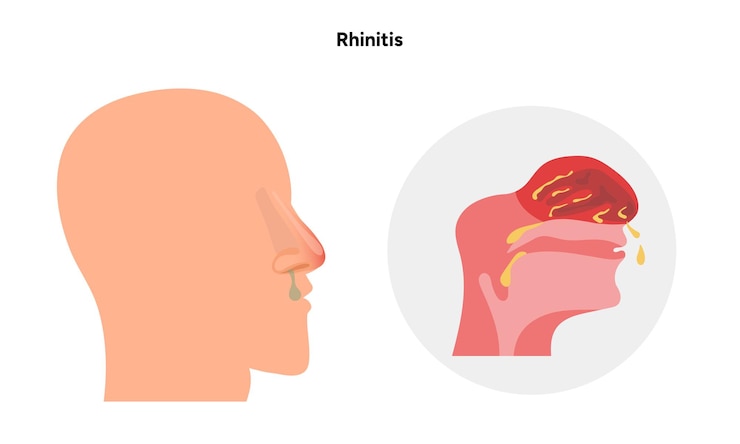 Vetor doenças nasais sintomas de rinite alergia diagrama médico de rinite ou resfriado