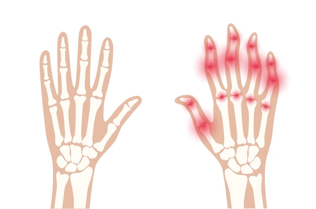 Vetor dor e inflamação em mãos no raio-x. sintoma de artrite reumatóide nas articulações humanas