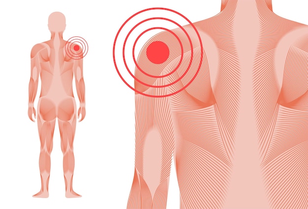 Dor no ombro ou escápula. silhueta do homem do sistema muscular. articulações e cartilagens no corpo humano