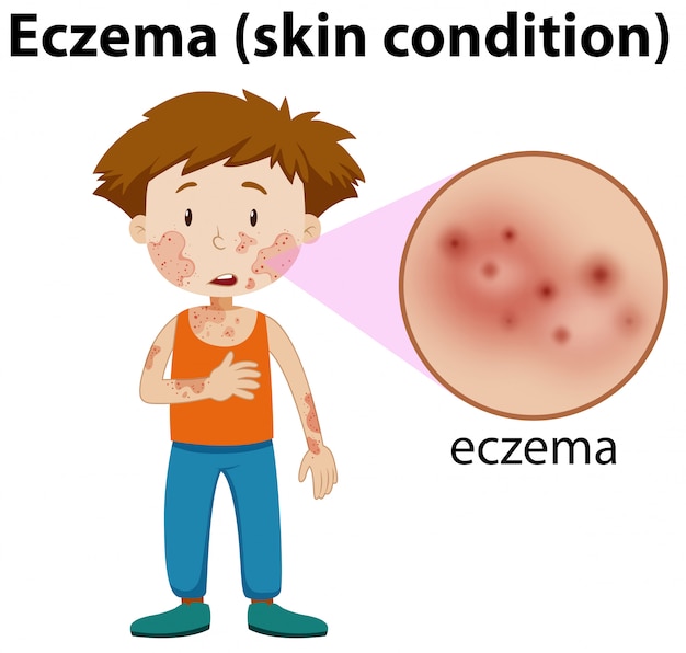 Eczema ampliada no menino