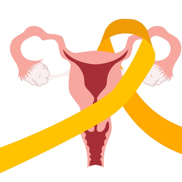 Vetor endometriose doenças do sistema reprodutivo feminino ovário suporte de fita amarela em ilustração plana