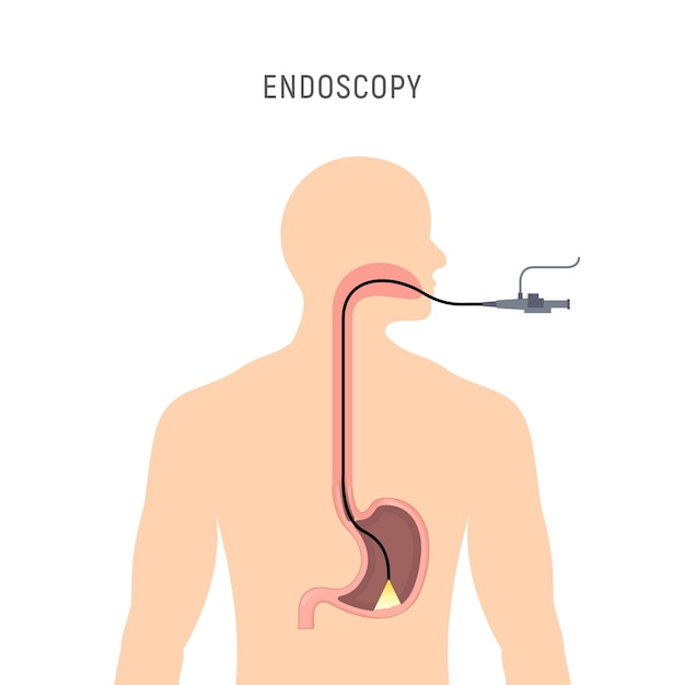 Vetor equipamento de anatomia de estômago de endoscopia ilustração vetorial endoscópio de esôfago exame corporal gastroscopia instrumento humano