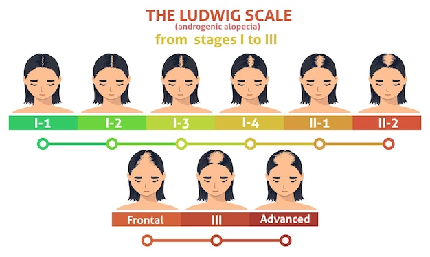 Vetor escala ludwig de cartaz de passo de alopecia androgenética