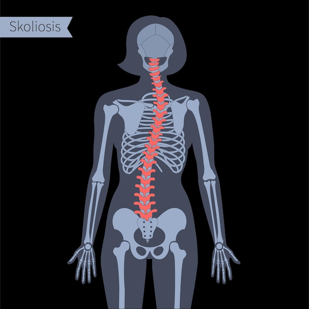 Escoliose combinada no corpo feminino. ilustração em vetor xray plana. anatomia da coluna vertebral, coluna vertebral, articulação e esqueleto na silhueta da mulher. cartaz ortopédico. banner médico. exame em centro de dor espinhal, clínica