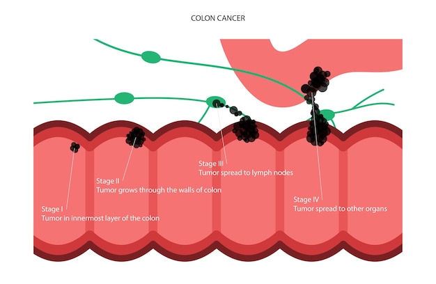 Vetor estágio do câncer de cólon