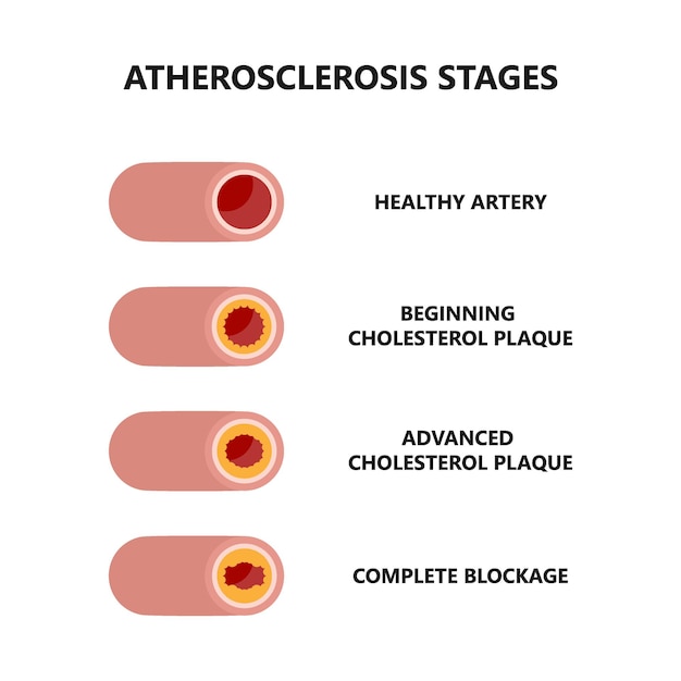 Estágios da aterosclerose. formação e crescimento da placa de colesterol. artérias saudáveis e insalubres.