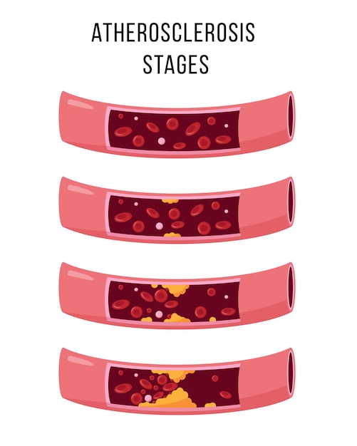Estágios da aterosclerose isolados no branco