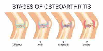 Vetor estágios de osteoartrite do joelho anatomia das articulações e dos ossos